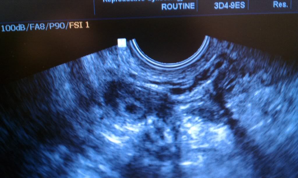 Ectopic photo 9ADDEF1E-orig.jpg